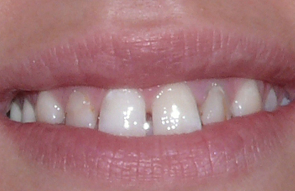 Smile design, Studio Dentistico Dott. Luca Lancieri. Specialista in odontostomatologia, protesi dentale, implantologia e parodontologia, Genova