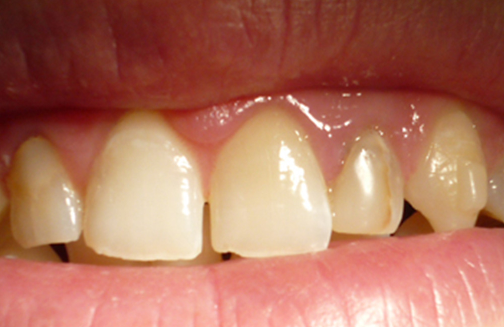 Smile design, Studio Dentistico Dott. Luca Lancieri. Specialista in odontostomatologia, protesi dentale, implantologia e parodontologia, Genova