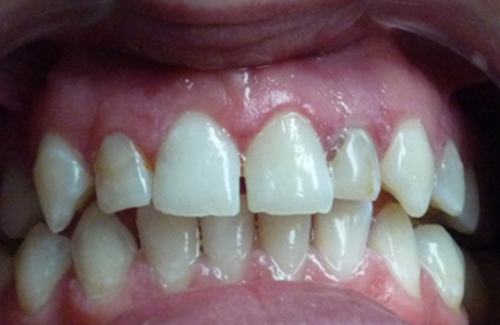 Smile design, Studio Dentistico Dott. Luca Lancieri. Specialista in odontostomatologia, protesi dentale, implantologia e parodontologia, Genova