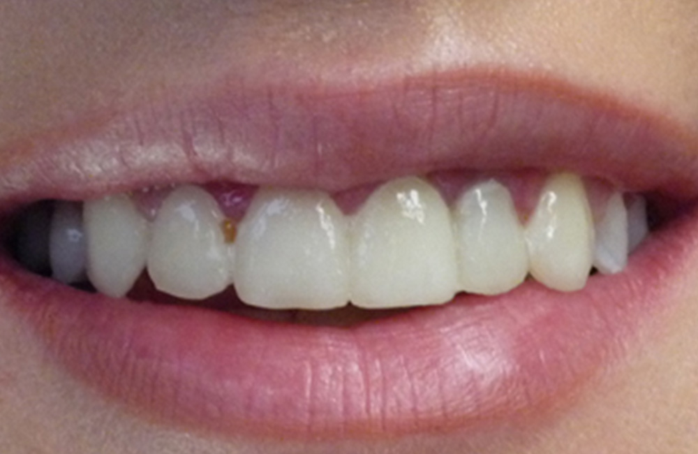 Smile design, Studio Dentistico Dott. Luca Lancieri. Specialista in odontostomatologia, protesi dentale, implantologia e parodontologia, Genova