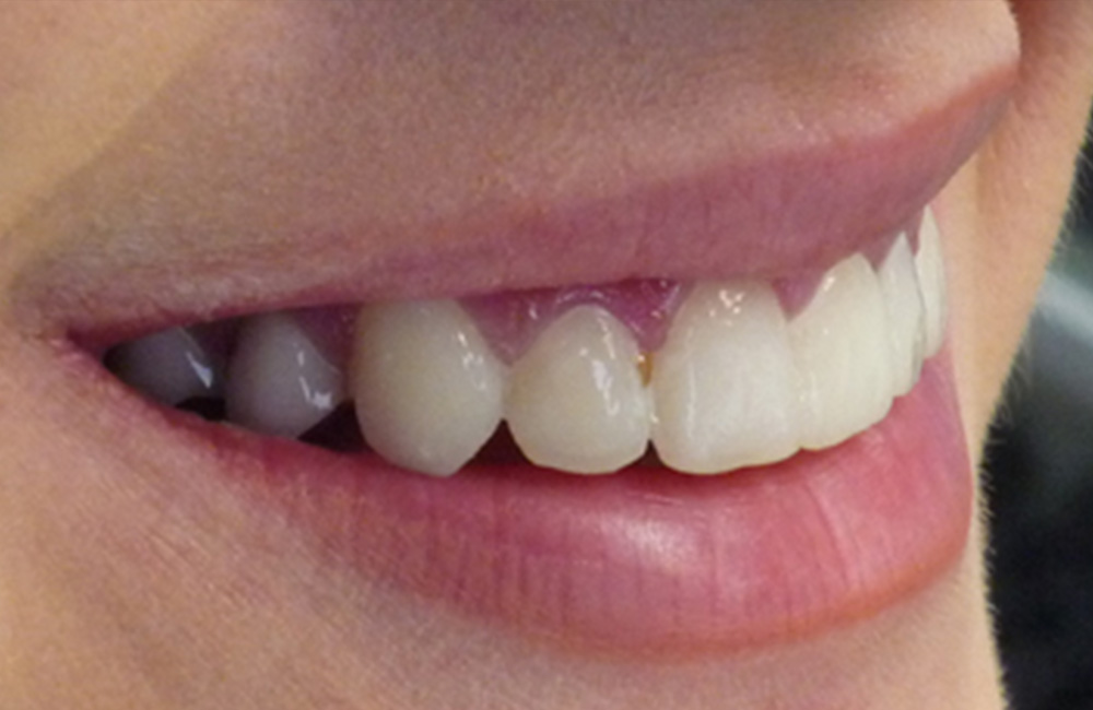 Smile design, Studio Dentistico Dott. Luca Lancieri. Specialista in odontostomatologia, protesi dentale, implantologia e parodontologia, Genova