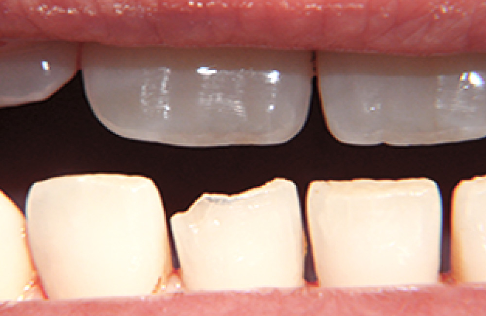 odontocosmesi, Studio Dentistico Dott. Luca Lancieri. Specialista in odontostomatologia, protesi dentale, implantologia e parodontologia, Genova