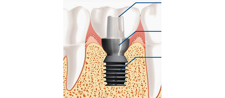 Short implants, Studio Dentistico Dott. Luca Lancieri. Specialista in odontostomatologia, protesi dentale, implantologia e parodontologia, Genova