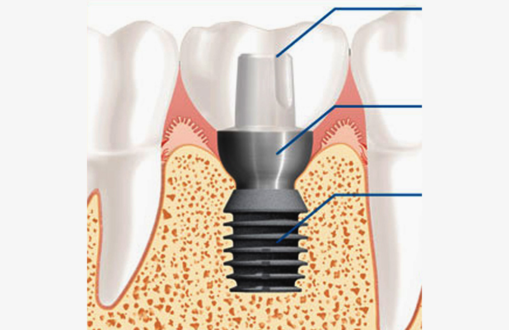 Short implants, Studio Dentistico Dott. Luca Lancieri. Specialista in odontostomatologia, protesi dentale, implantologia e parodontologia, Genova