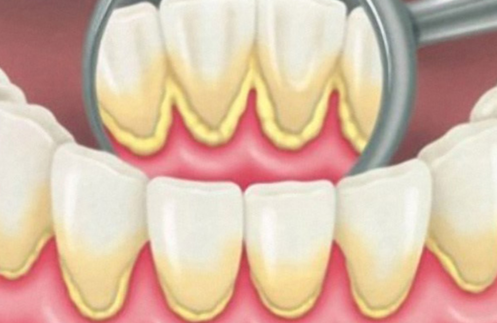 Rimozione placca, Studio Dentistico Dott. Luca Lancieri. Specialista in odontostomatologia, protesi dentale, implantologia e parodontologia, Genova