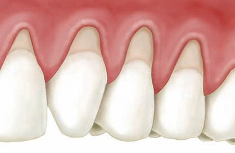 Malattie gengivali, Studio Dentistico Dott. Luca Lancieri. Specialista in odontostomatologia, protesi dentale, implantologia e parodontologia, Genova
