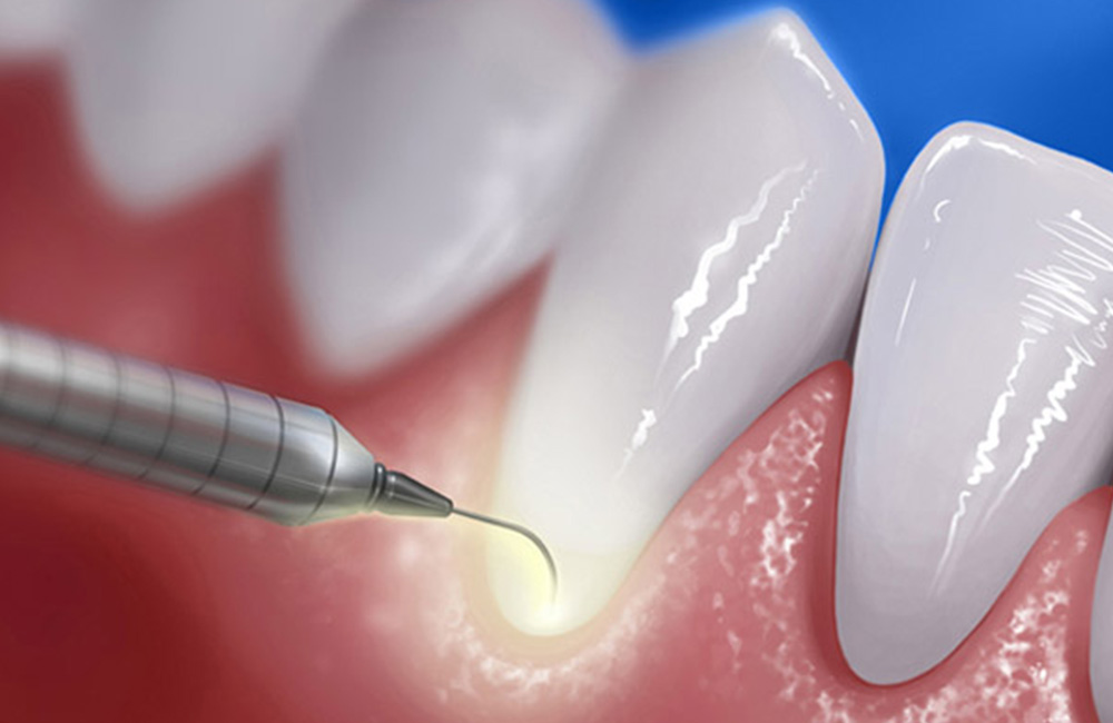 Laser paradontale, Studio Dentistico Dott. Luca Lancieri. Specialista in odontostomatologia, protesi dentale, implantologia e parodontologia, Genova